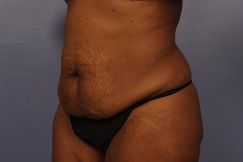 Tummy Tuck Before & After Image