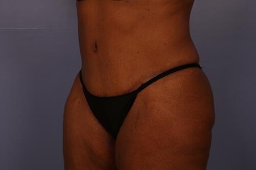 Tummy Tuck Before & After Image