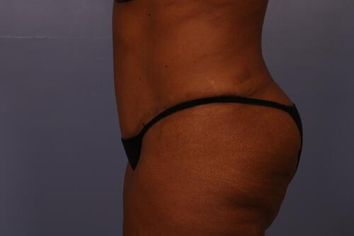 Tummy Tuck Before & After Image