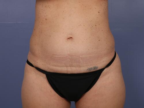 Tummy Tuck Before & After Image