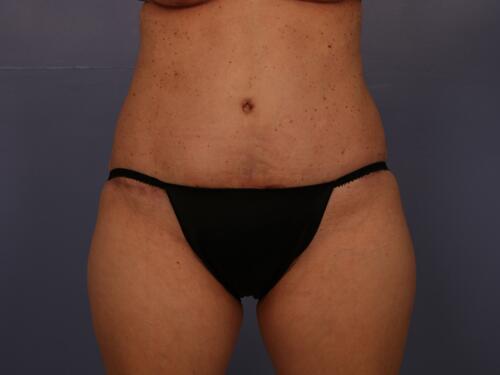 Tummy Tuck Before & After Image