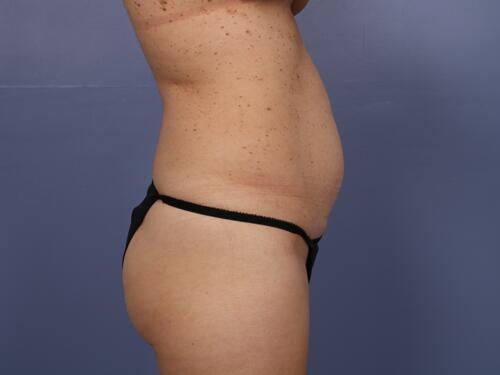 Tummy Tuck Before & After Image