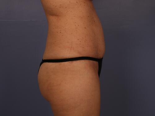 Tummy Tuck Before & After Image