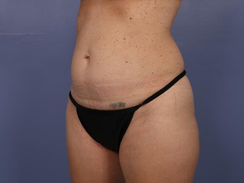 Tummy Tuck Before & After Image