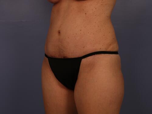 Tummy Tuck Before & After Image