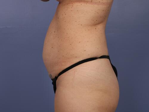 Tummy Tuck Before & After Image