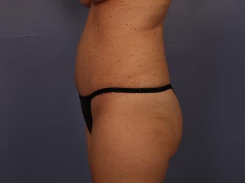 Tummy Tuck Before & After Image