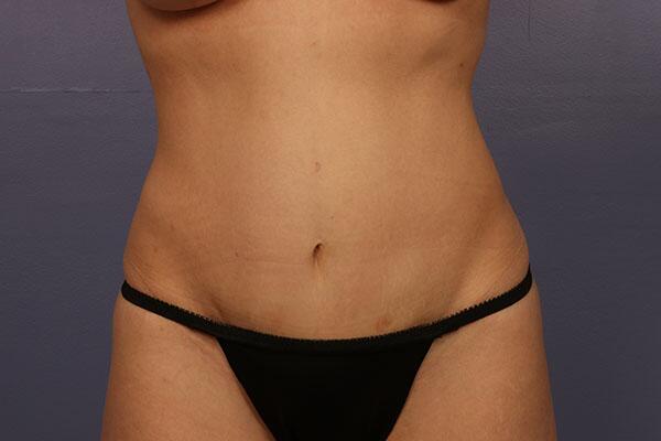 Tummy Tuck Before & After Image