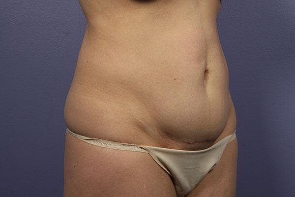 Tummy Tuck Before & After Image