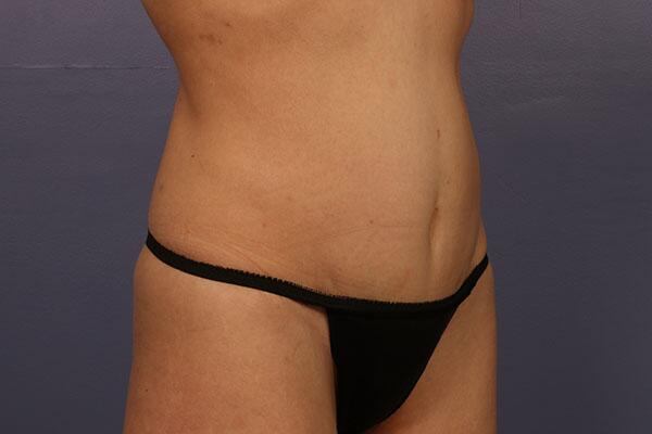 Tummy Tuck Before & After Image