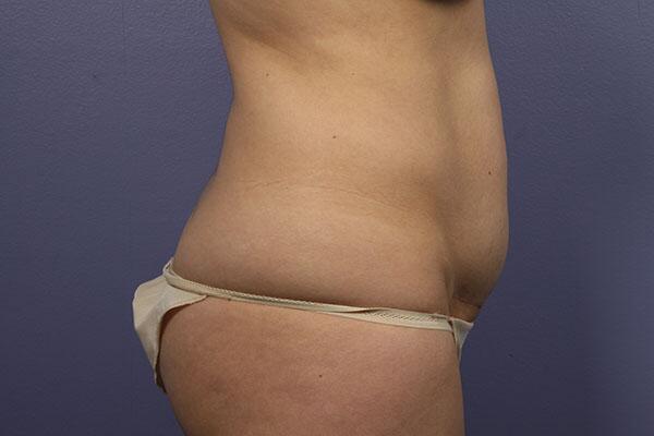 Tummy Tuck Before & After Image