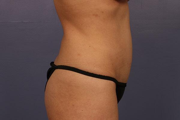 Tummy Tuck Before & After Image