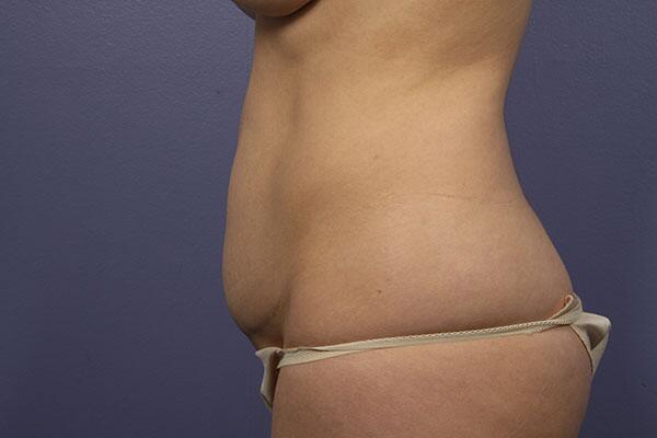 Tummy Tuck Before & After Image