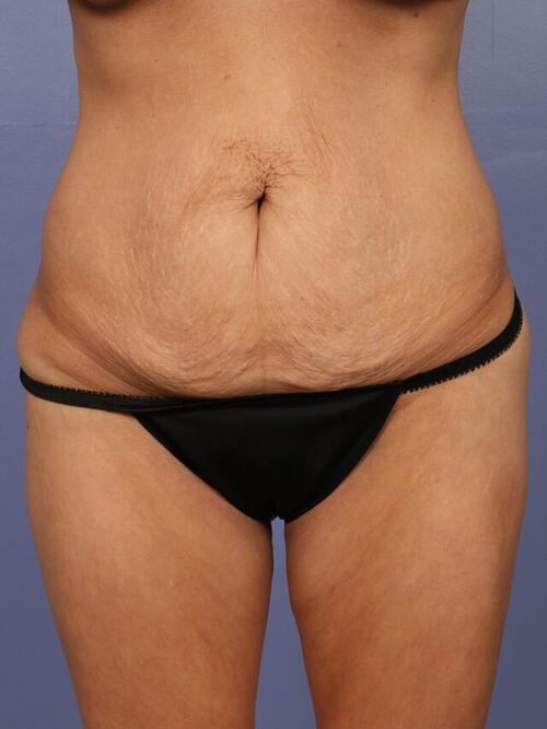 Tummy Tuck Before & After Image