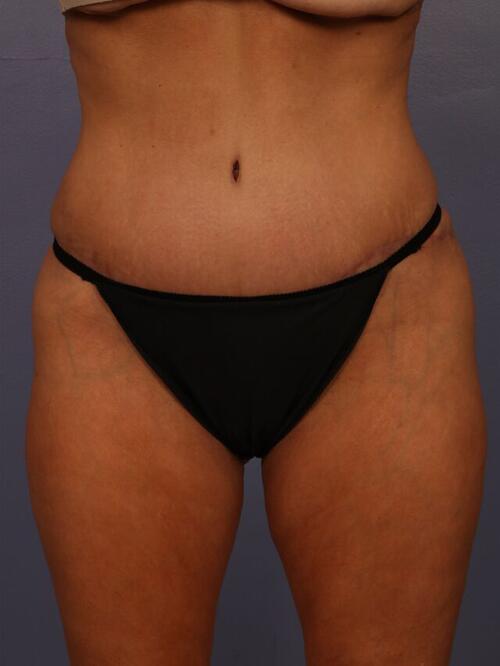 Tummy Tuck Before & After Image