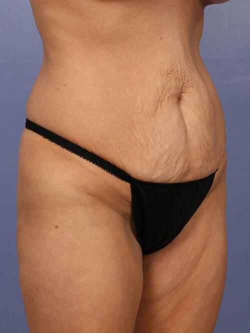 Tummy Tuck Before & After Image