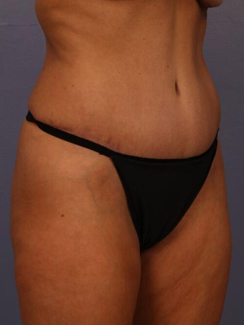 Tummy Tuck Before & After Image