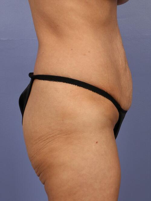 Tummy Tuck Before & After Image