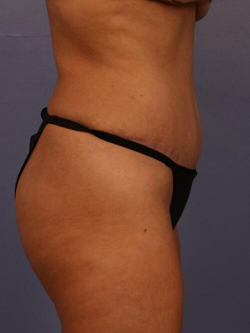 Tummy Tuck Before & After Image