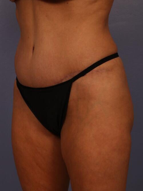 Tummy Tuck Before & After Image