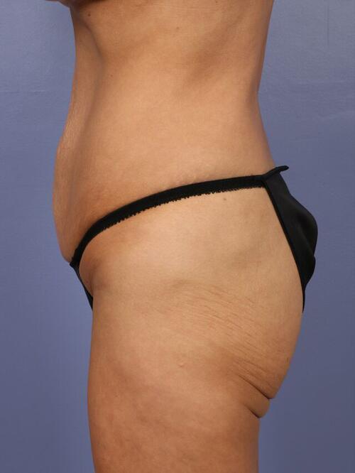 Tummy Tuck Before & After Image