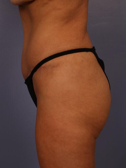 Tummy Tuck Before & After Image