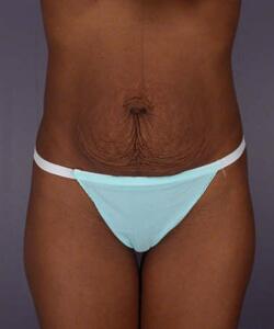 Tummy Tuck Before & After Image