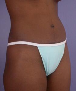 Tummy Tuck Before & After Image