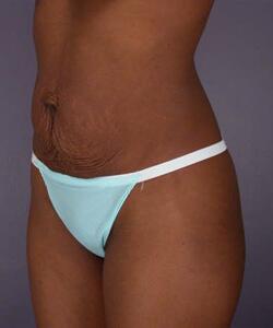 Tummy Tuck Before & After Image