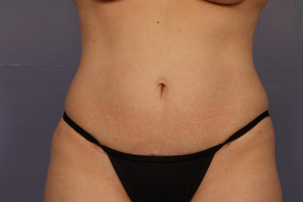 Tummy Tuck Before & After Image