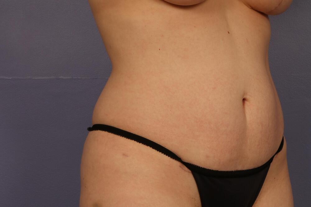 Tummy Tuck Before & After Image