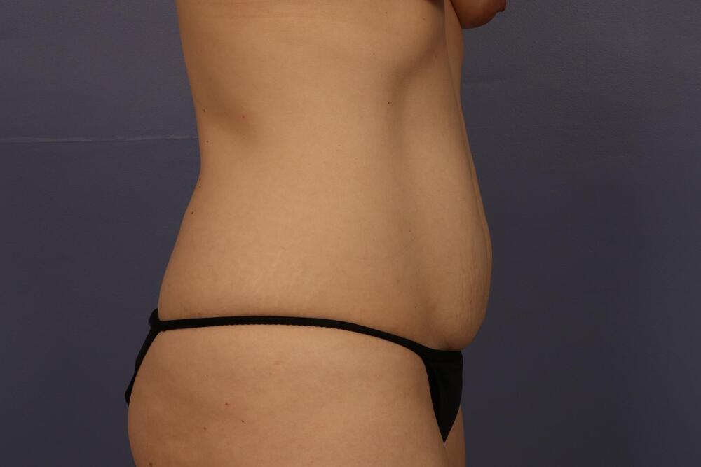 Tummy Tuck Before & After Image