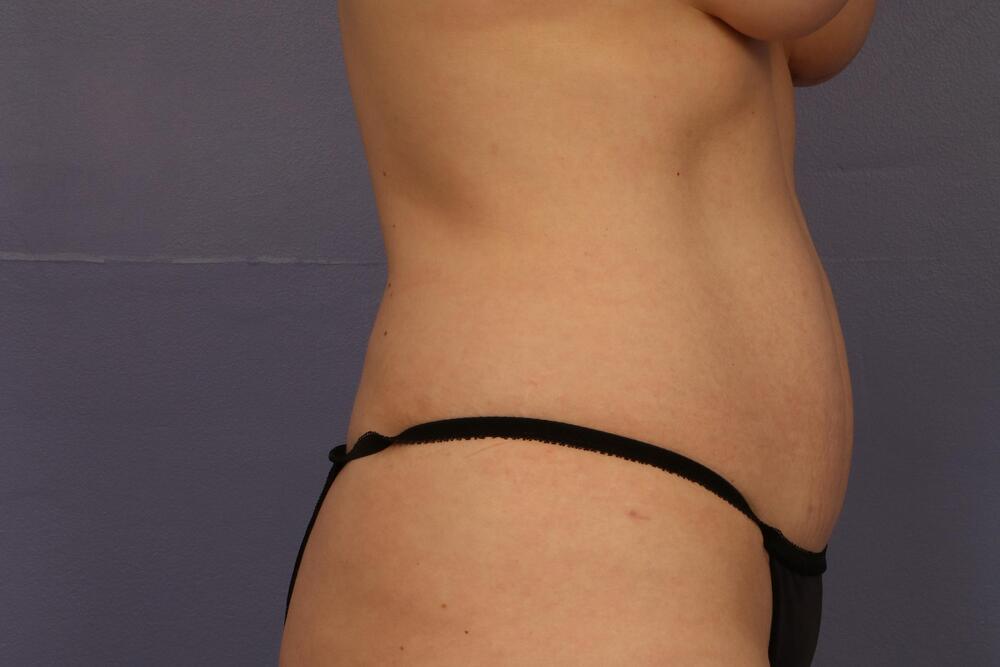 Tummy Tuck Before & After Image