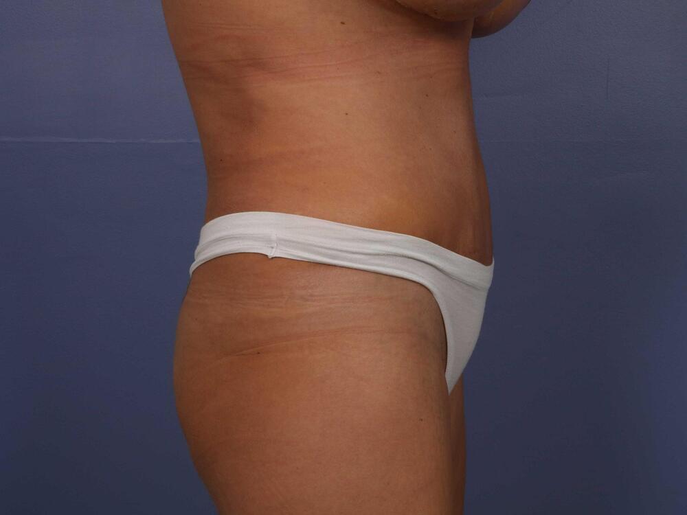 Tummy Tuck Before & After Image