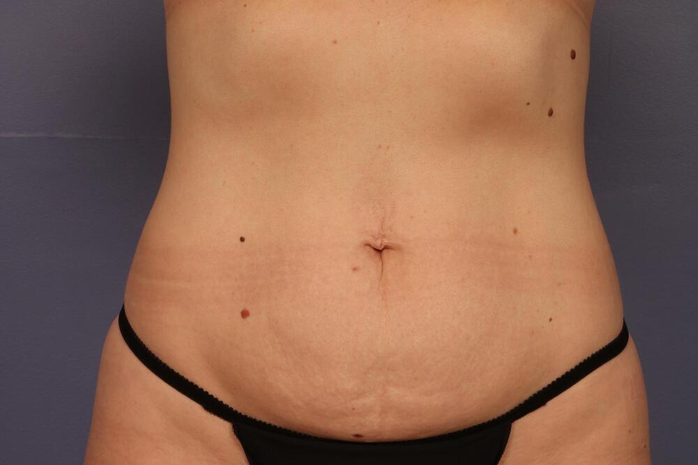 Tummy Tuck Before & After Image