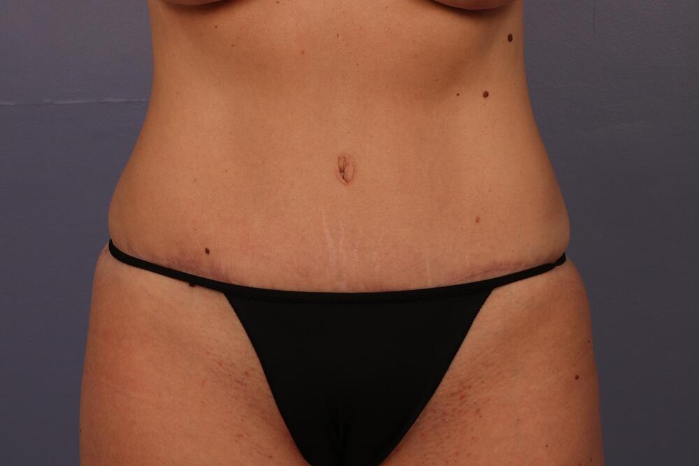 Tummy Tuck Before & After Image