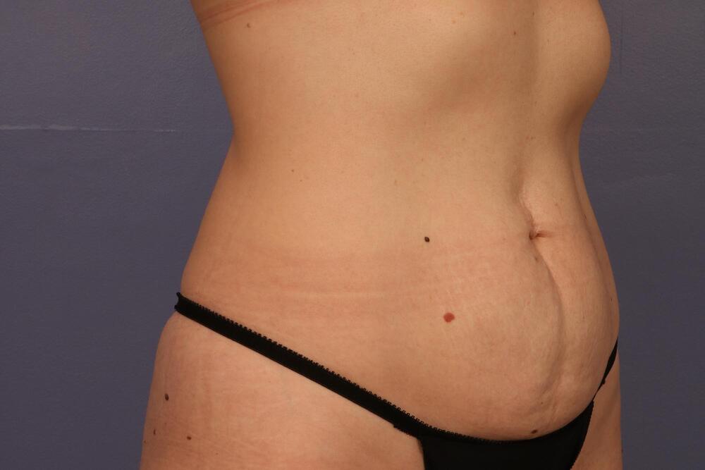 Tummy Tuck Before & After Image