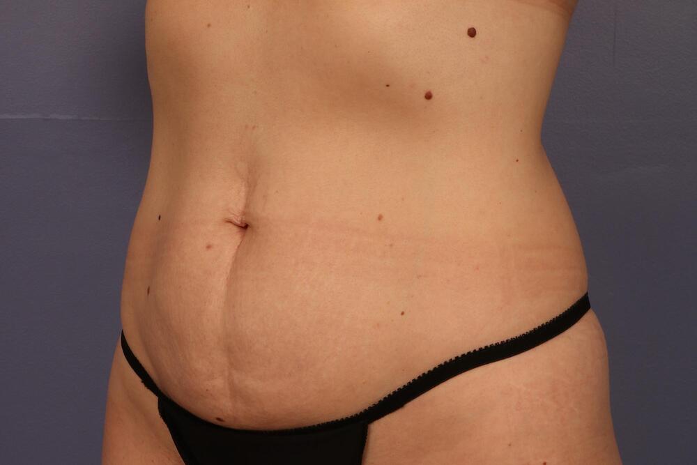 Tummy Tuck Before & After Image