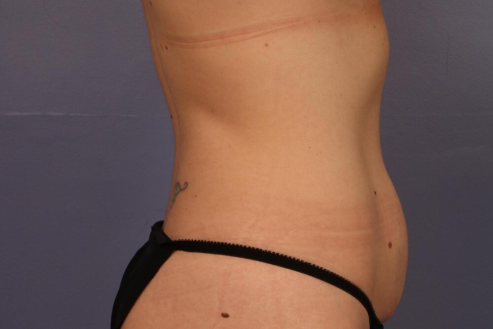 Tummy Tuck Before & After Image