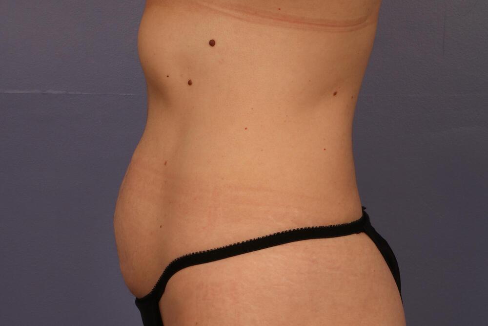 Tummy Tuck Before & After Image