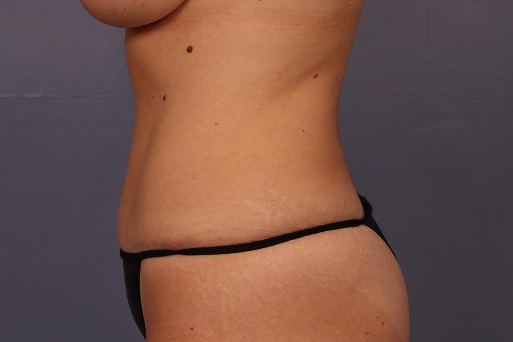 Tummy Tuck Before & After Image