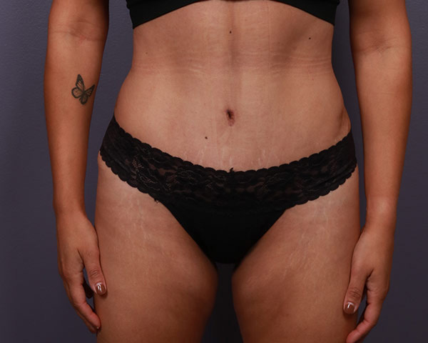 Tummy Tuck Before & After Image