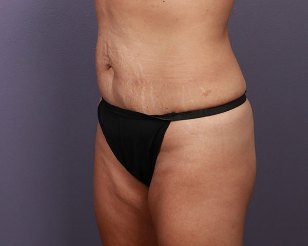 Tummy Tuck Before & After Image