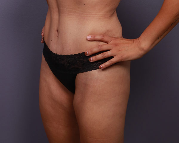 Tummy Tuck Before & After Image