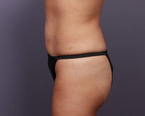 Tummy Tuck Before & After Image