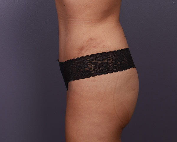 Tummy Tuck Before & After Image