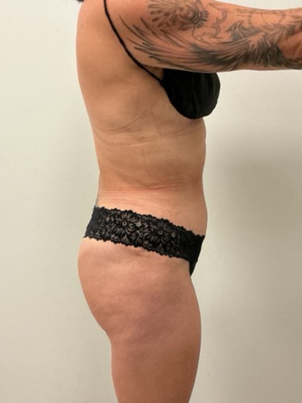 Tummy Tuck Before & After Image