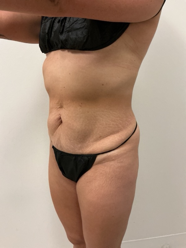 Tummy Tuck Before & After Image