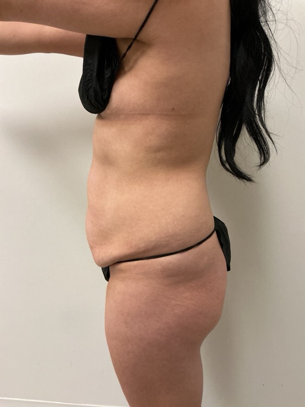 Tummy Tuck Before & After Image