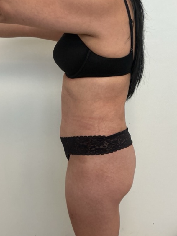 Tummy Tuck Before & After Image